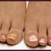 Лечение грибка ногтей на ногах
